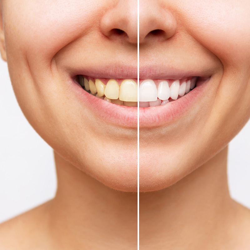 The image displays a side-by-side comparison of a person s teeth before and after dental treatment, showcasing a transformation from discolored to clean and white teeth.
