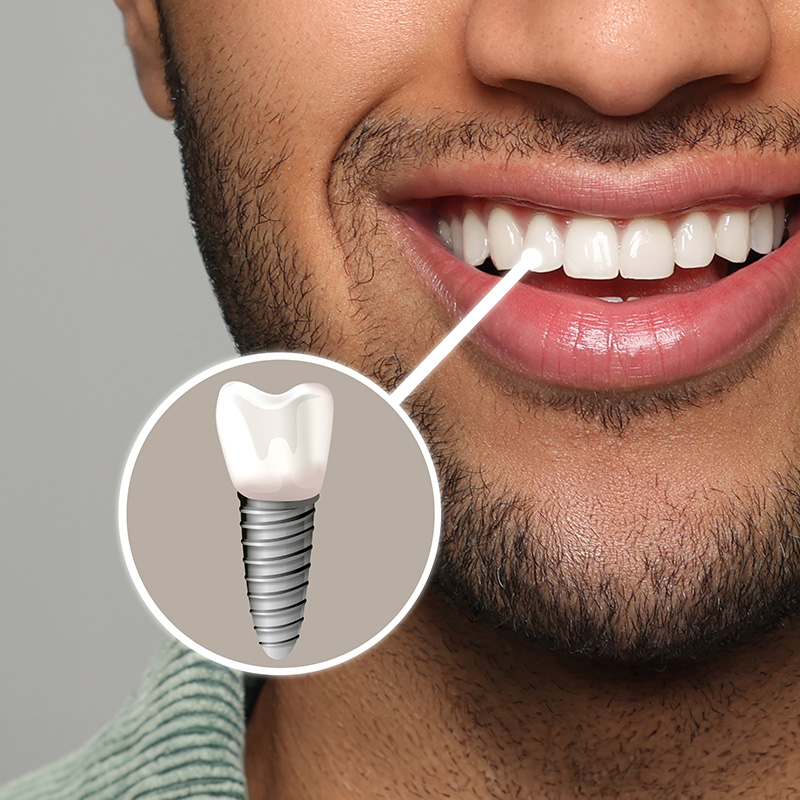 The image shows a smiling individual with a toothpaste advertisement overlaying the image, featuring a close-up of a tooth with a screw inserted into it, highlighting dental implant technology.